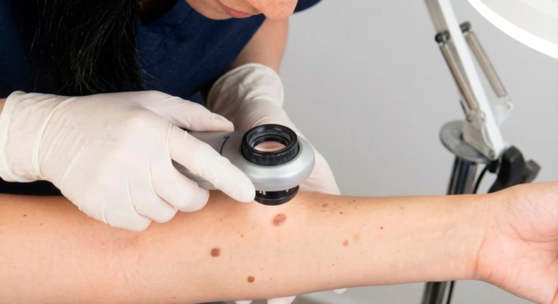 Revisión de lunares con dermatoscopio
